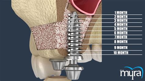 sinus lift port salerno fl|Sinus Lift: Procedure, Cost, Recovery, and More .